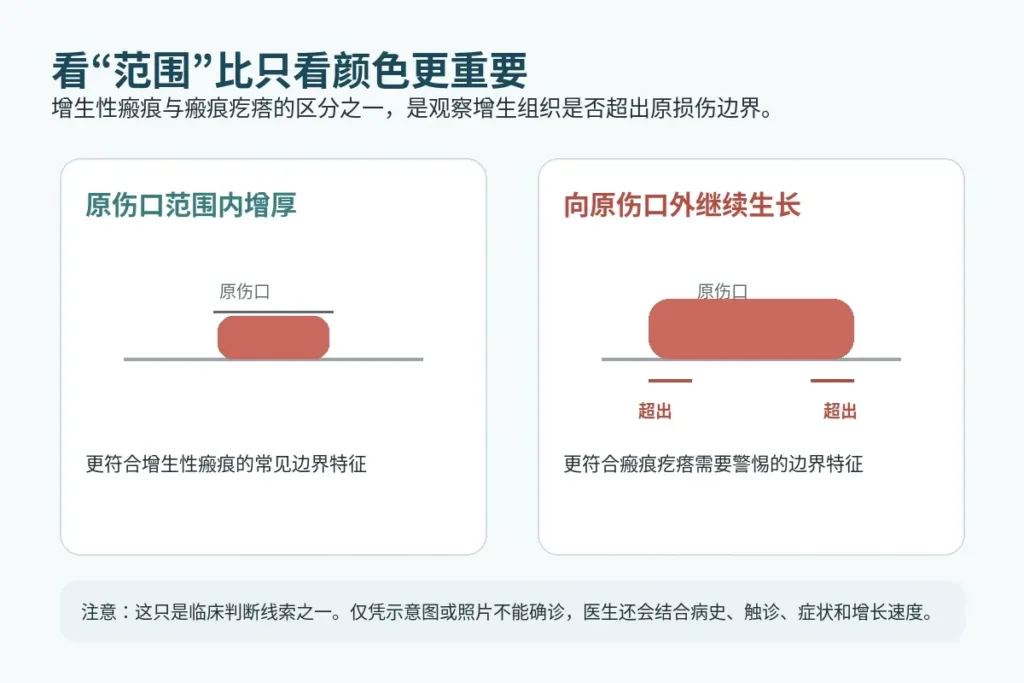 增生性瘢痕在原伤口范围内增厚与瘢痕疙瘩超出原损伤边界的示意对比