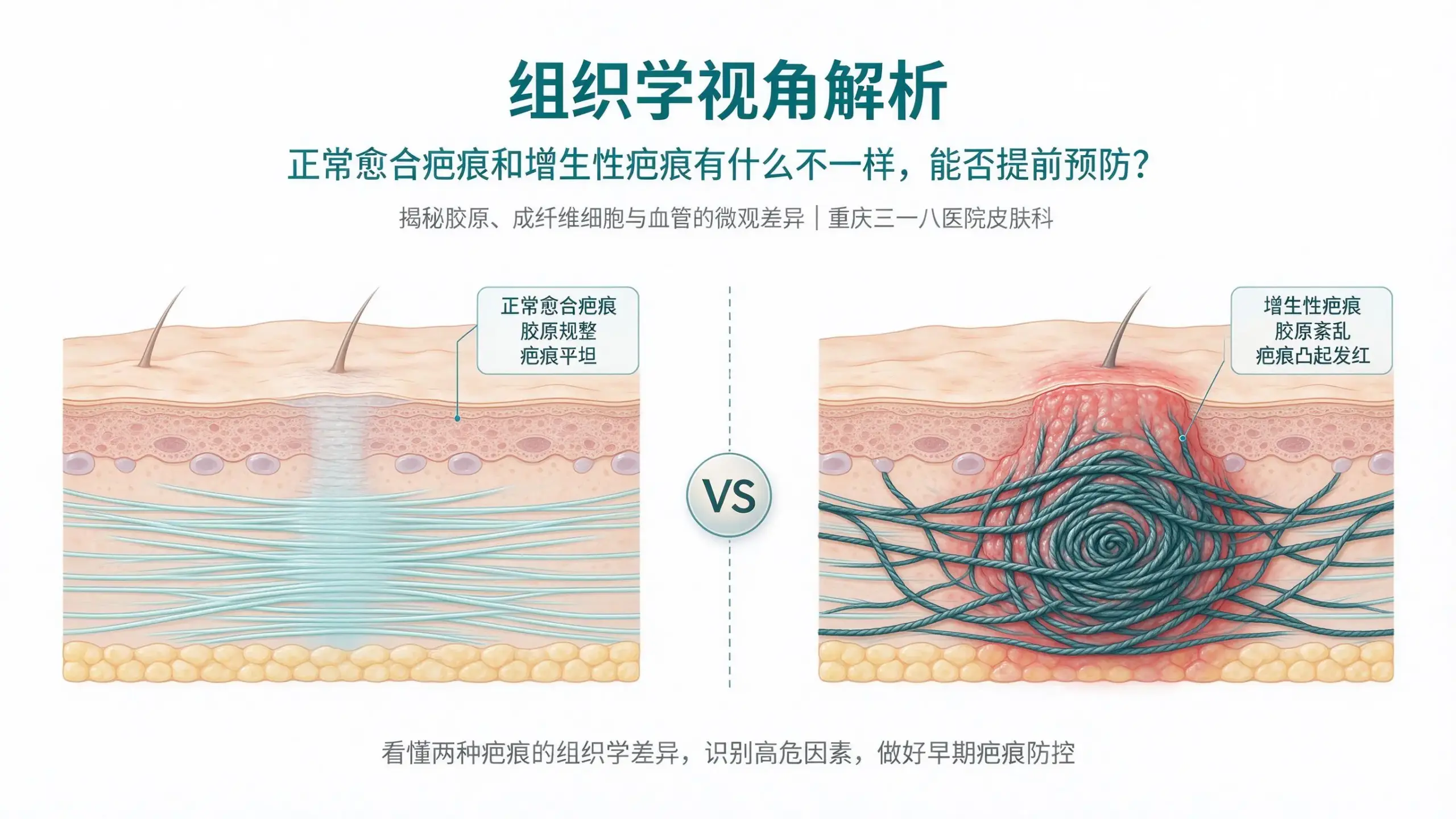 组织学解析正常愈合疤痕和增生性疤痕的区别，疤痕早期预防科普｜重庆三一八医院皮肤科