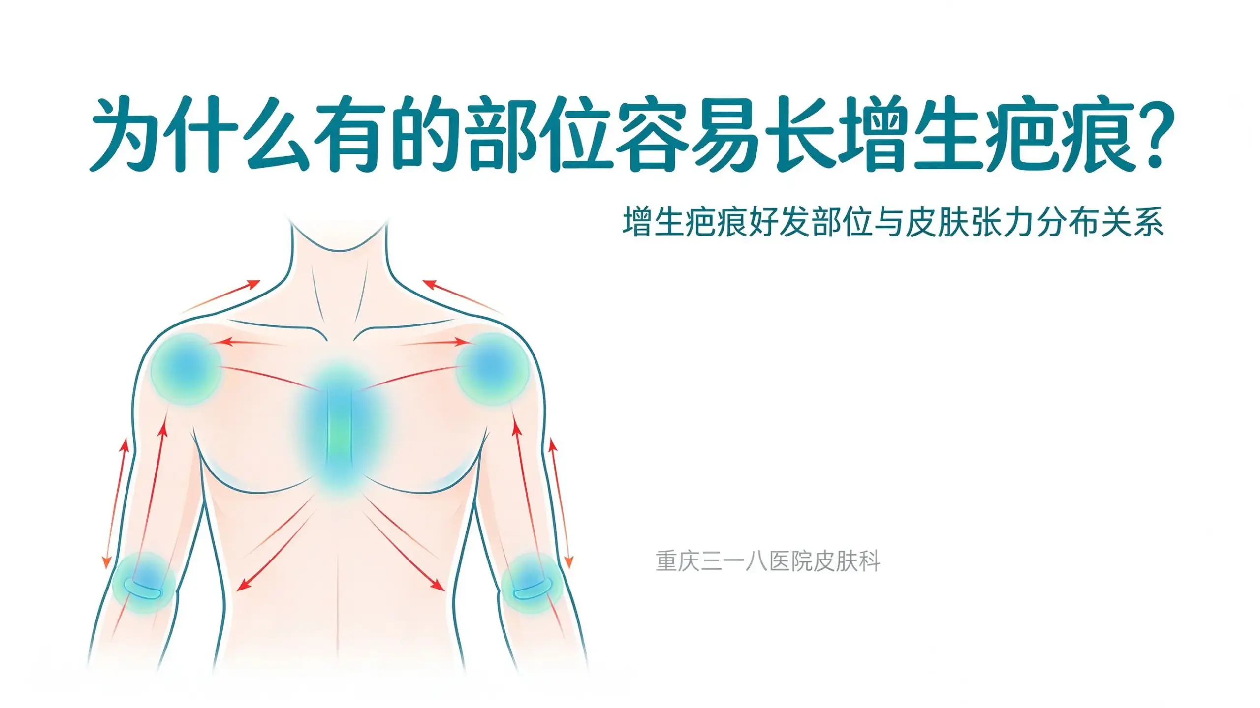 增生疤痕好发部位与皮肤张力分布关系科普头图,前胸肩背关节高张力区标注
